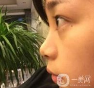 上海瑞金医院王辉隆鼻价格一览表，附整形案例在线展示