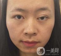 河南省立眼科医院做上脸下垂怎么样?价格表和真人果图展示