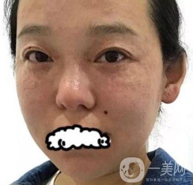 哈医大四院整形美容科*新价格表公布,附祛斑真人案例