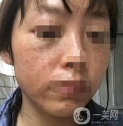 漳州175医院整形美容科价格表（收费表）,及祛斑案例果分享