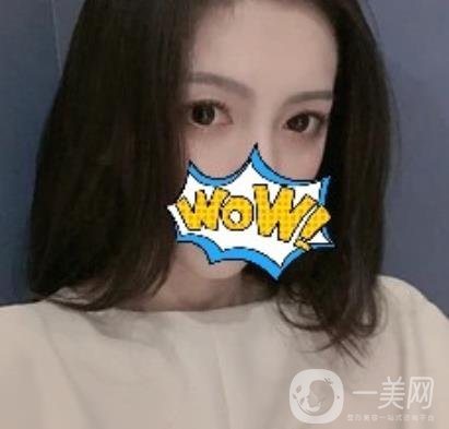 武汉艾莱美医疗整形医院价格表项目收费明细，附双眼皮案例