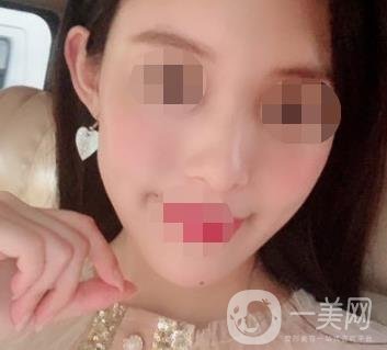 南大一附院整形美容科价格表2020版及祛疤案例