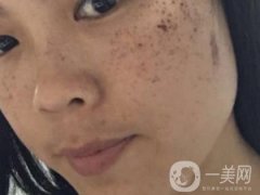 北京星美整形医院祛斑如何？附案例和价格表