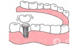 郑州种植牙价格贵不贵？多少钱？全新口碑牙科医院推荐