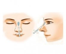 玻尿酸注射隆鼻术后的注意事项