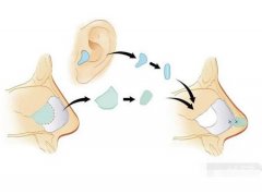 矫正鹰钩鼻的步骤是怎么样的