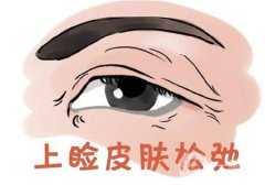 眼皮为什么会下垂以及如何矫正