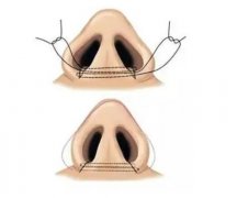 鼻翼外切手术留下疤痕怎么办？