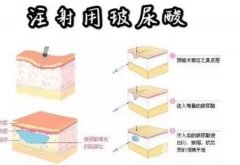 玻尿酸填充眼窝有什么作用？