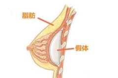 硅胶隆胸的安全性怎么样？痛吗