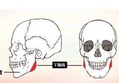 颧骨整形手术有副作用吗？